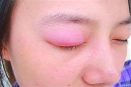 眼皮肿